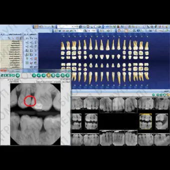 Программное обеспечение для обработки снимков зубов DEXIS