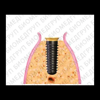 Цилиндрический конический зубной имплантат IDMAX
