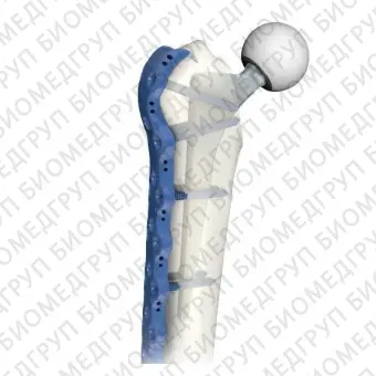 Компрессионная костная пластина для перипротезного перелома бедра 7.0 ChLP
