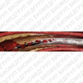 Катетер тромбэктомии XpressWay RX