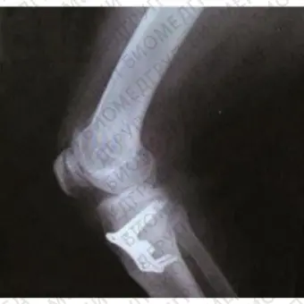 Костная пластина для остеотомии большеберцовая кость OWO